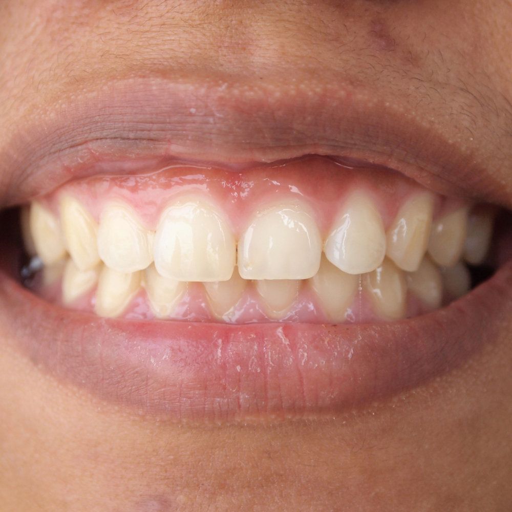 Slightly Receded Gums