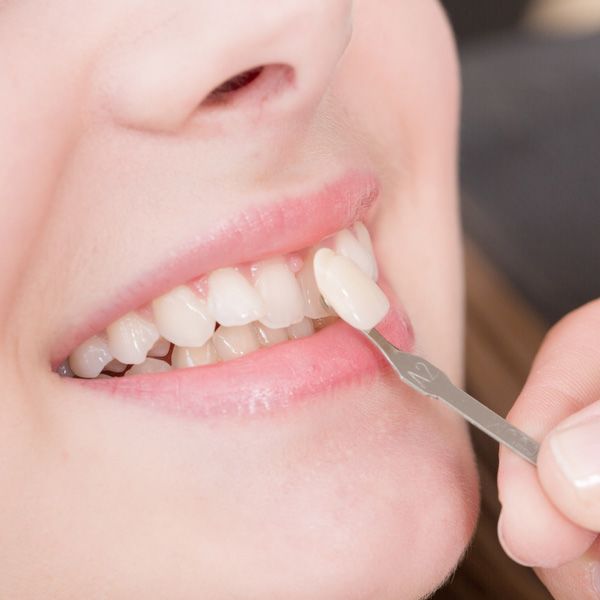 Porcelain veneers