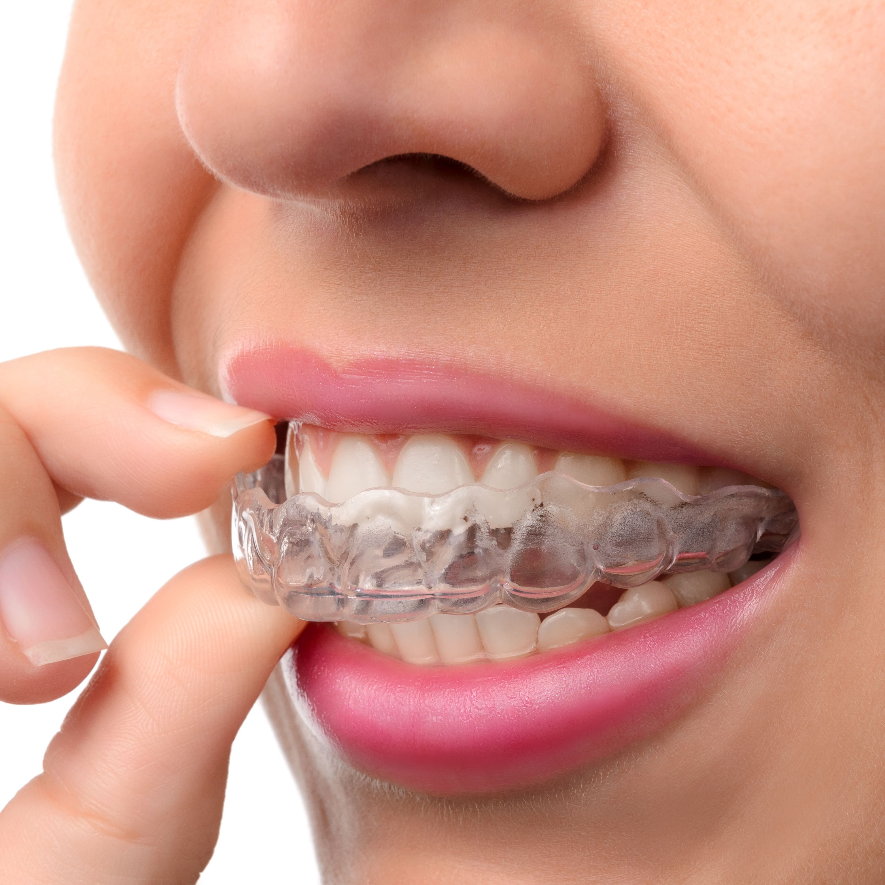 Patient putting on SureSmile aligner