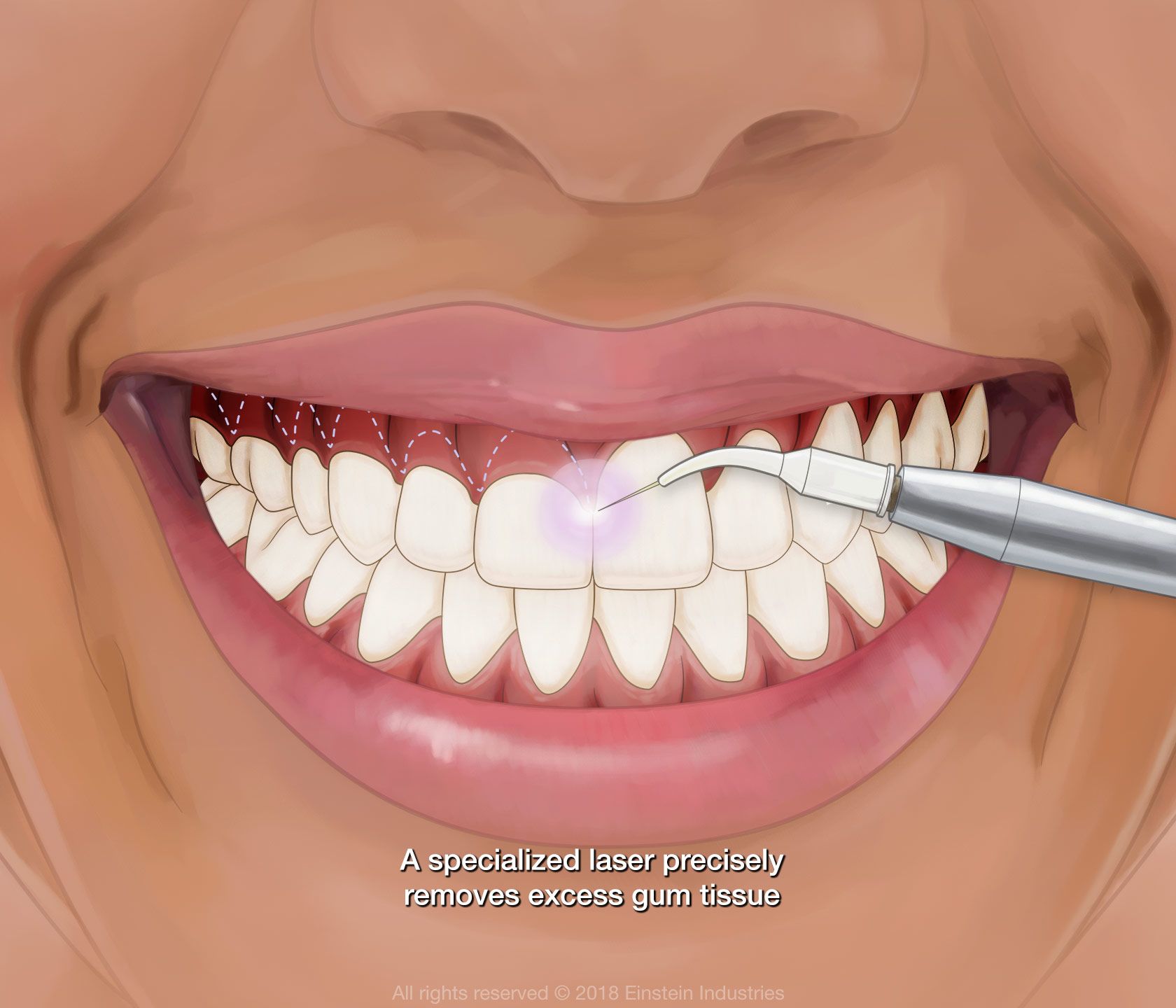 Illustration of gummy smile