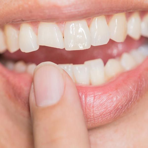 Fractured Front Tooth