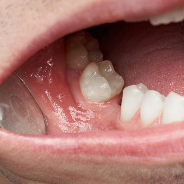 Missing Tooth